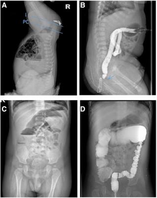 Anorectal malformation combined with Hirschsprung's disease: a case report